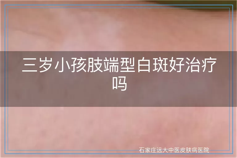 三岁小孩肢端型白斑好治疗吗