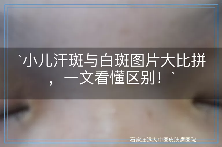 小儿汗斑与白斑图片大比拼，一文看懂区别！