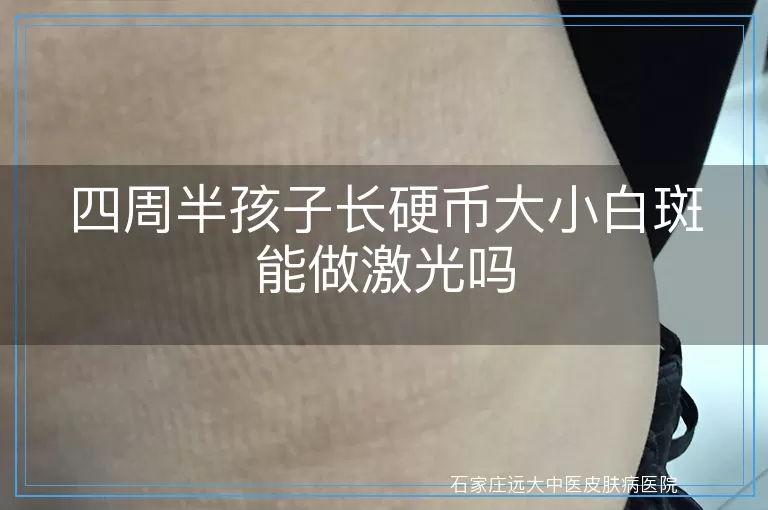 四周半孩子长硬币大小白斑能做激光吗