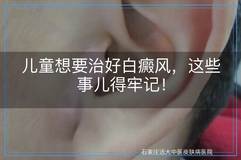 儿童想要治好白癜风，这些事儿得牢记！