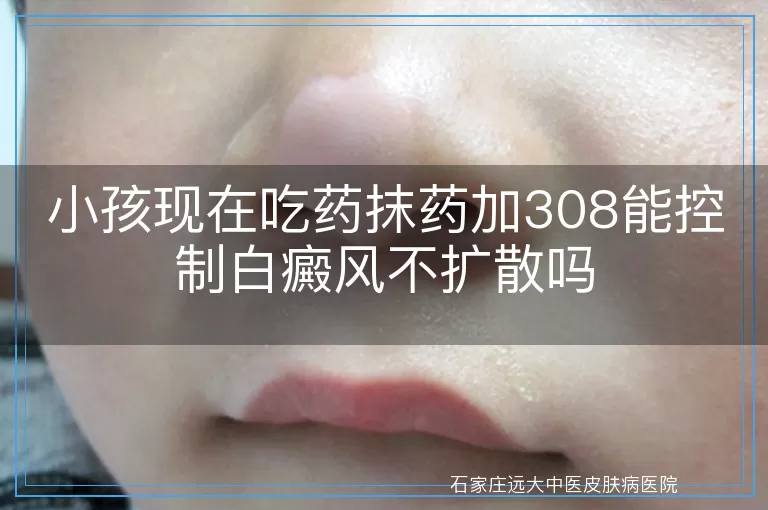 小孩现在吃药抹药加308能控制白癜风不扩散吗