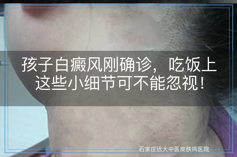 孩子白癜风刚确诊，吃饭上这些小细节可不能忽视！