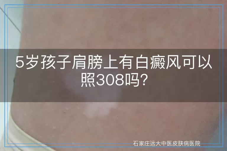5岁孩子肩膀上有白癜风可以照308吗?