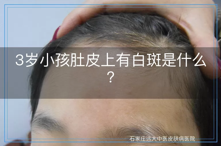 3岁小孩肚皮上有白斑是什么?