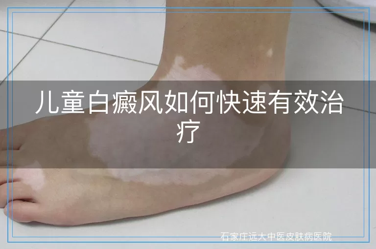 儿童白癜风如何快速有效治疗