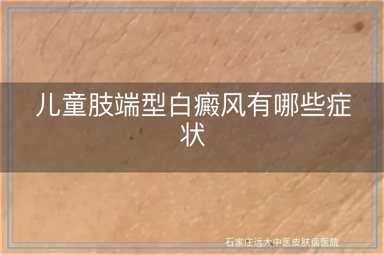 儿童肢端型白癜风有哪些症状