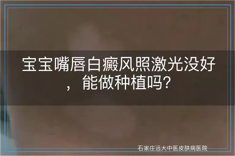 宝宝嘴唇白癜风照激光没好，能做种植吗？