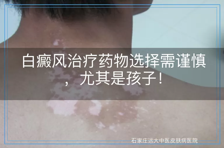 白癜风治疗药物选择需谨慎，尤其是孩子！