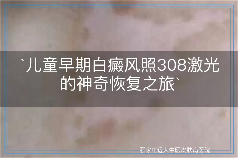 儿童早期白癜风照308激光的神奇恢复之旅