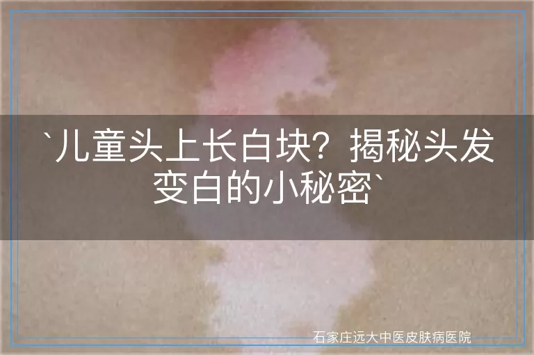 儿童头上长白块？揭秘头发变白的小秘密