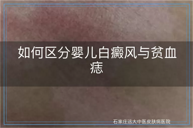 如何区分婴儿白癜风与贫血痣