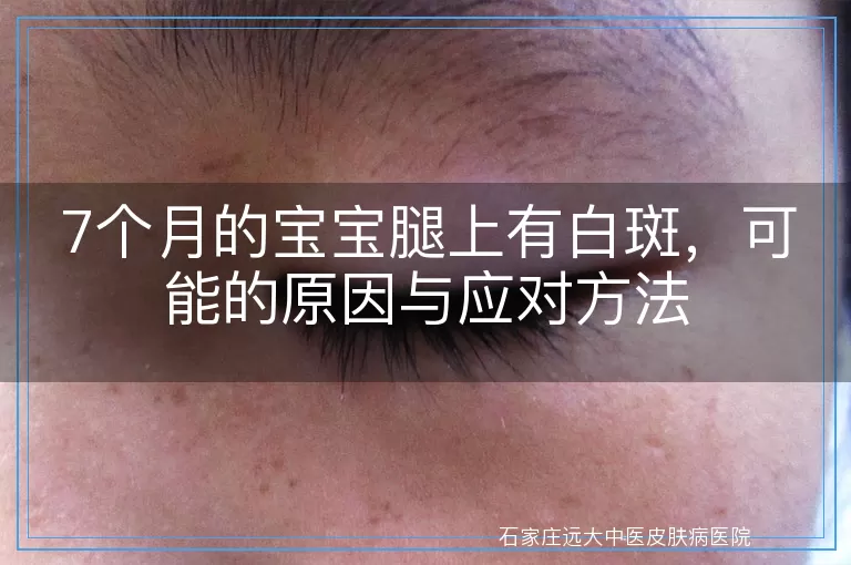 7个月的宝宝腿上有白斑，可能的原因与应对方法
