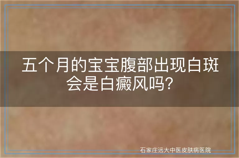 五个月的宝宝腹部出现白斑会是白癜风吗？