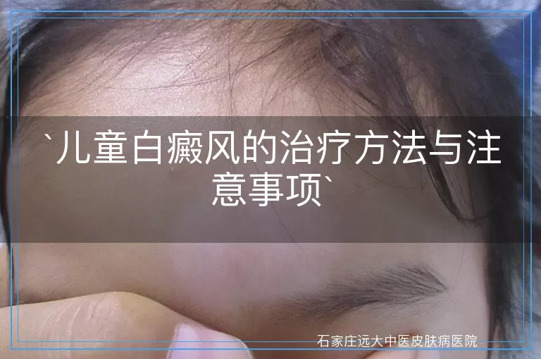 儿童白癜风的治疗方法与注意事项