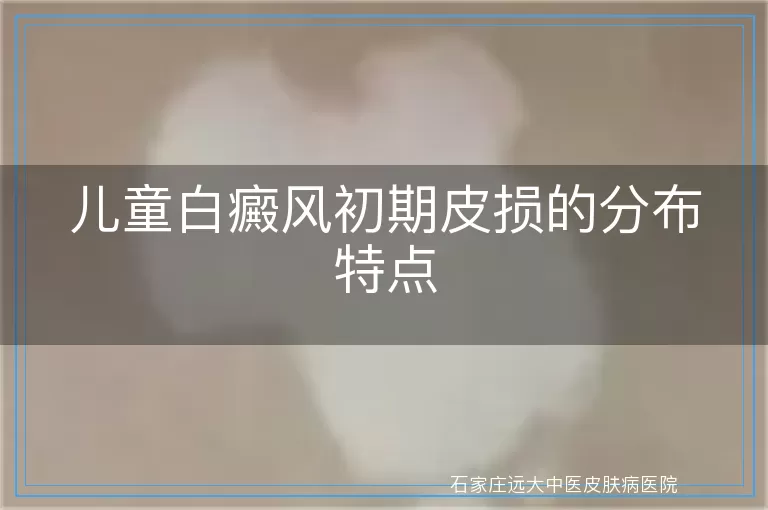 儿童白癜风初期皮损的分布特点