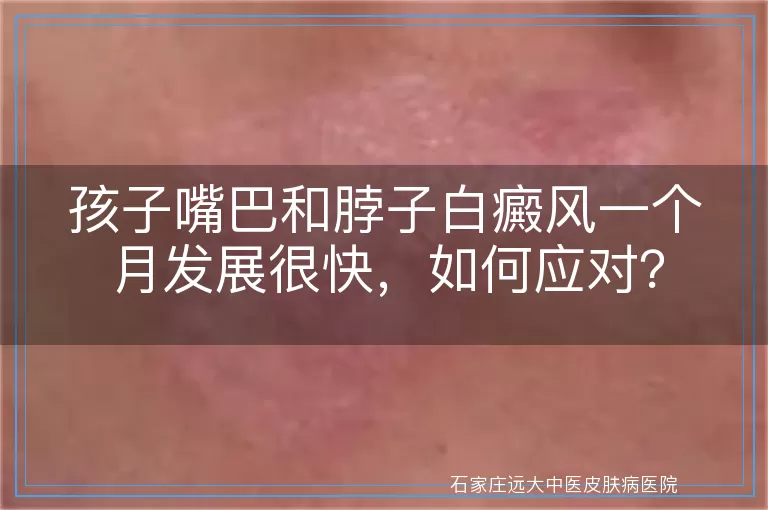 孩子嘴巴和脖子白癜风一个月发展很快，如何应对？