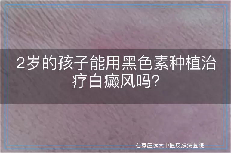 2岁的孩子能用黑色素种植治疗白癜风吗？