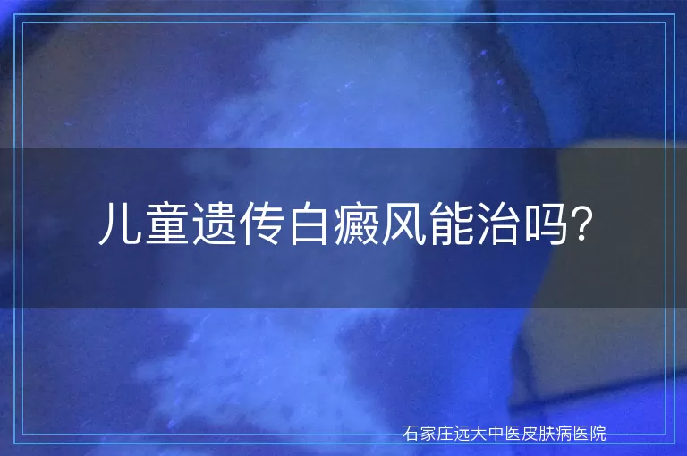 儿童遗传白癜风能治吗？