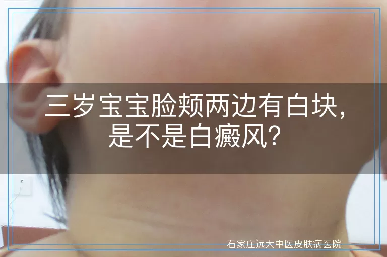 三岁宝宝脸颊两边有白块,是不是白癜风?
