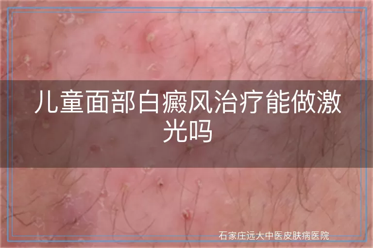 儿童面部白癜风治疗能做激光吗