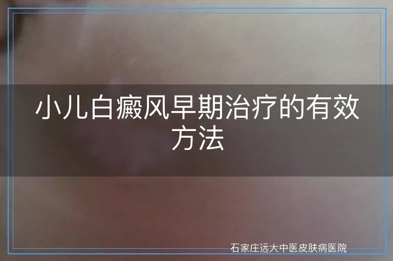 小儿白癜风早期治疗的有效方法