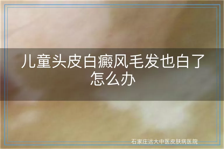 儿童头皮白癜风毛发也白了怎么办