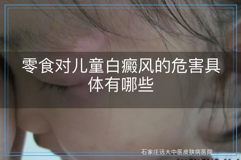 零食对儿童白癜风的危害具体有哪些