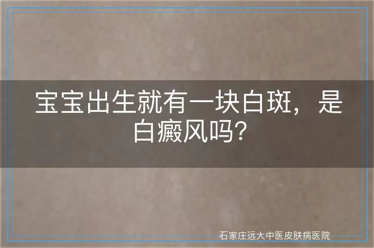 宝宝出生就有一块白斑，是白癜风吗？