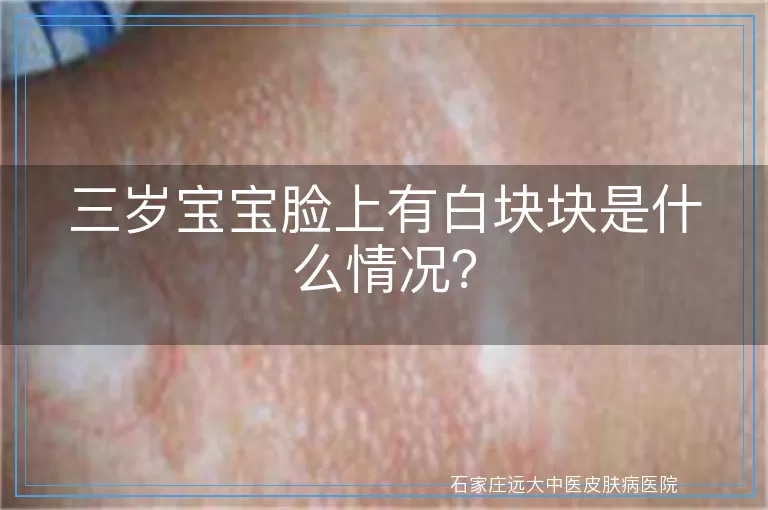 三岁宝宝脸上有白块块是什么情况？