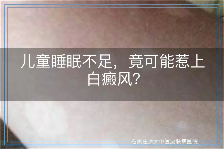 儿童睡眠不足，竟可能惹上白癜风？