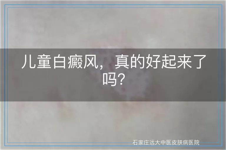 儿童白癜风，真的好起来了吗？