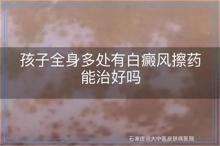 孩子全身多处有白癜风擦药能治好吗