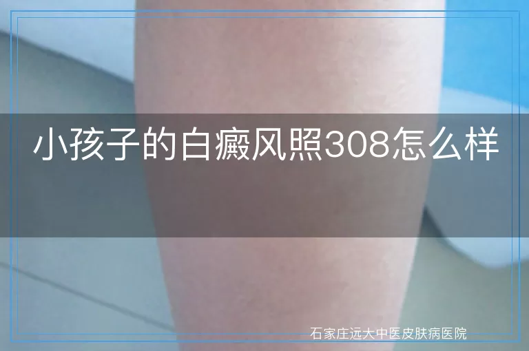 小孩子的白癜风照308怎么样