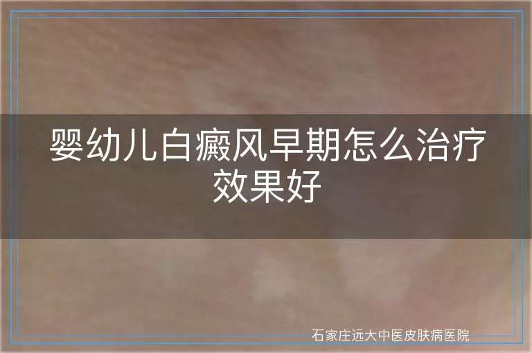 婴幼儿白癜风早期怎么治疗效果好