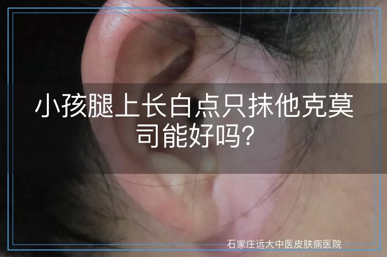 小孩腿上长白点只抹他克莫司能好吗？
