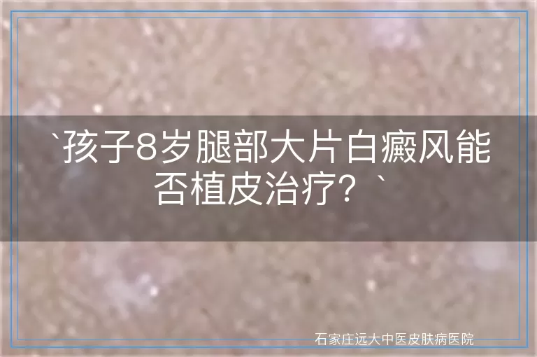孩子8岁腿部大片白癜风能否植皮治疗？