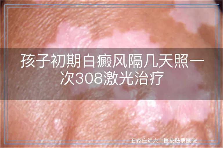 孩子初期白癜风隔几天照一次308激光治疗
