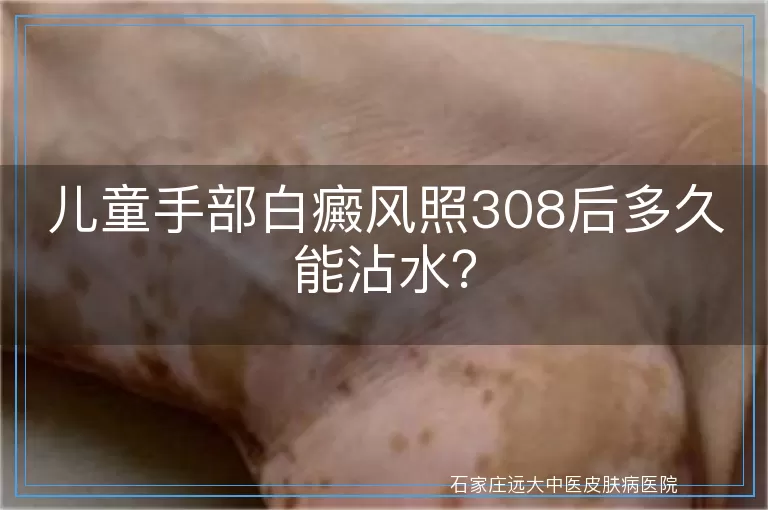 儿童手部白癜风照308后多久能沾水？