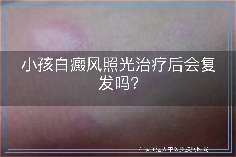 小孩白癜风照光治疗后会复发吗？