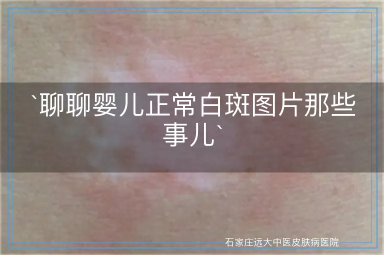 聊聊婴儿正常白斑图片那些事儿