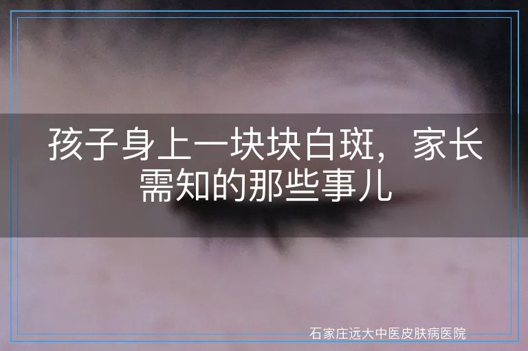 孩子身上一块块白斑，家长需知的那些事儿