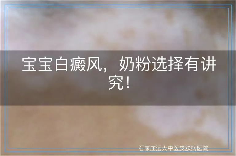 宝宝白癜风，奶粉选择有讲究！