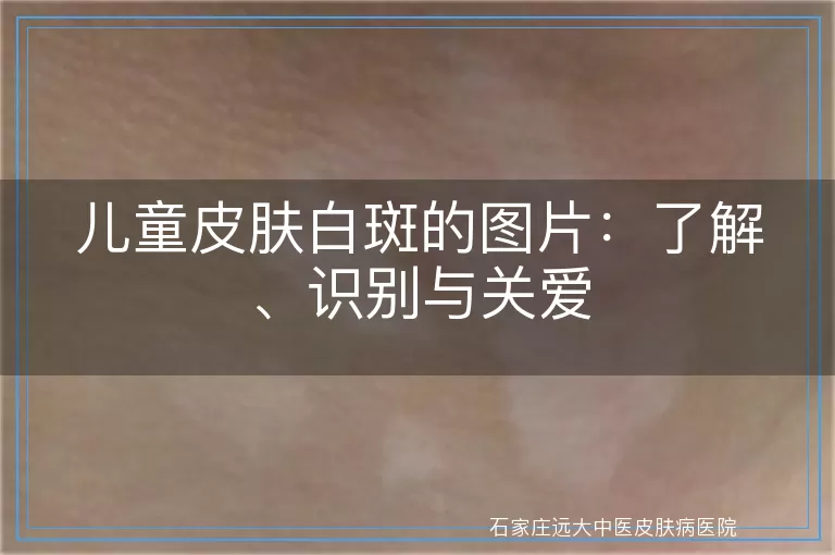 儿童皮肤白斑的图片：了解、识别与关爱