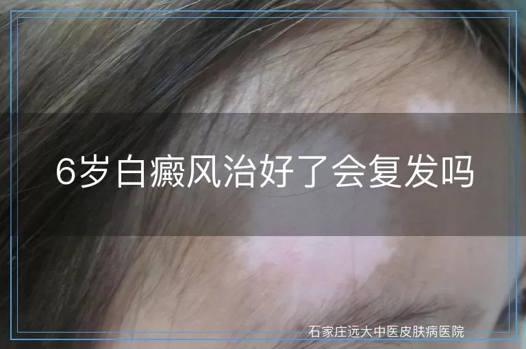 6岁白癜风治好了会复发吗