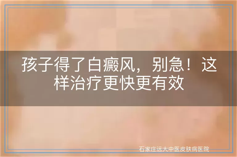 孩子得了白癜风，别急！这样治疗更快更有效