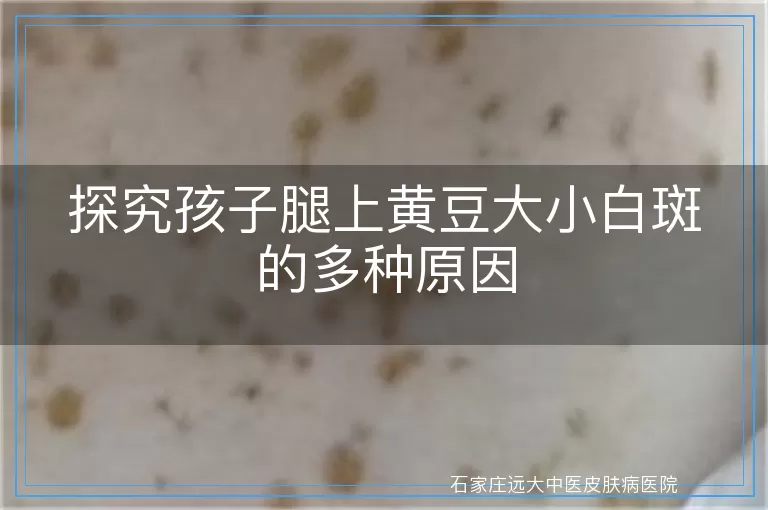探究孩子腿上黄豆大小白斑的多种原因