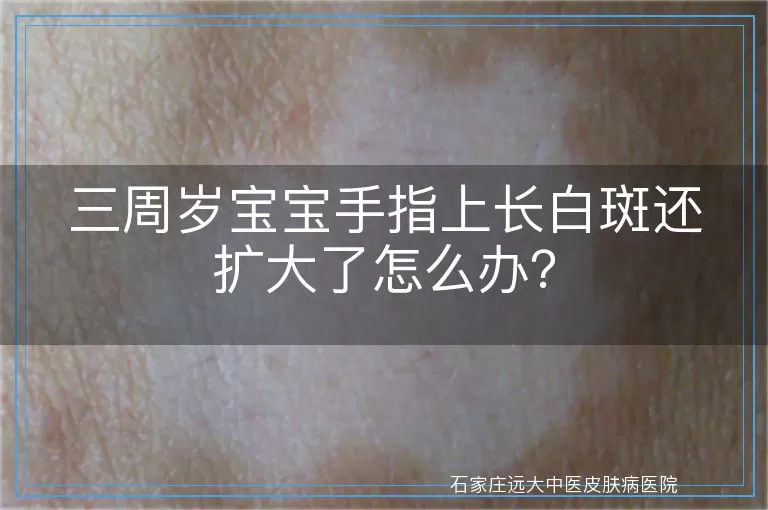 三周岁宝宝手指上长白斑还扩大了怎么办？