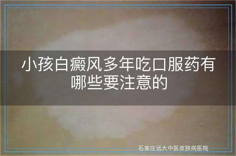 小孩白癜风多年吃口服药有哪些要注意的