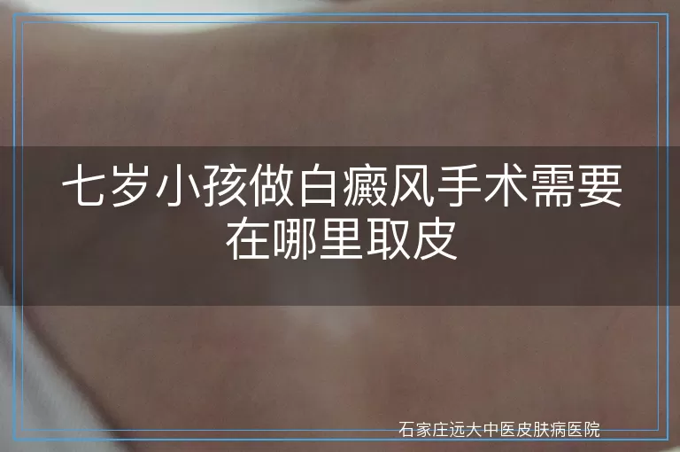 七岁小孩做白癜风手术需要在哪里取皮