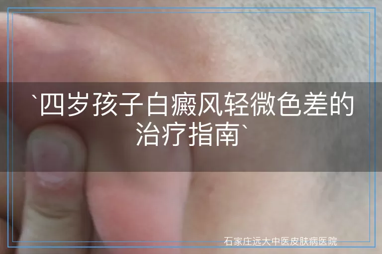 四岁孩子白癜风轻微色差的治疗指南